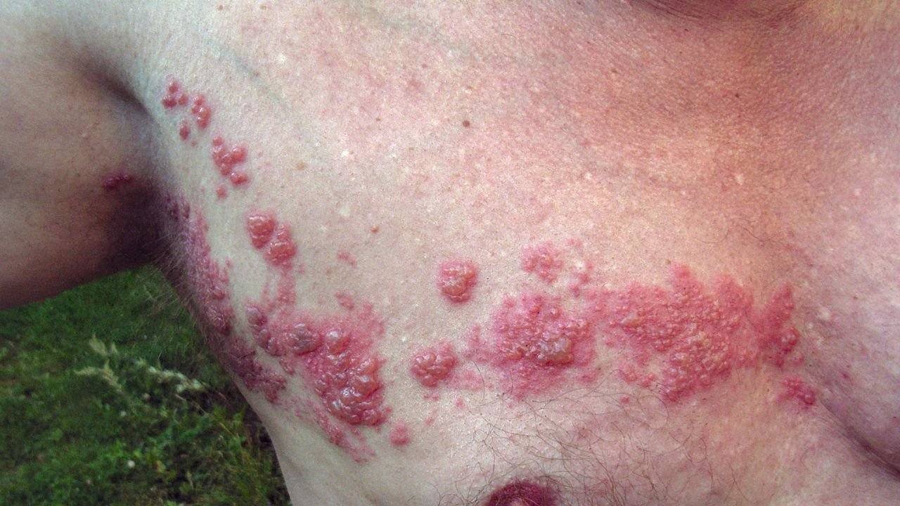 Is It A Crime To Not Disclose Herpes